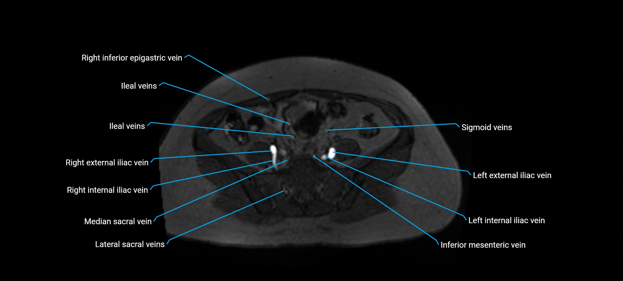 MRV abdomen pelvis & lower limb axial cross sectional anatomy labelled MRI image 134 (1).webp